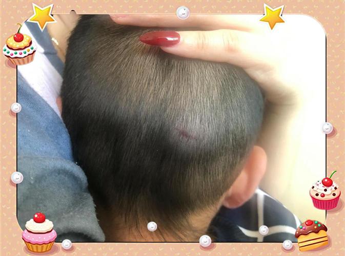 幼儿摔倒后头部磕出肿包的真实场景