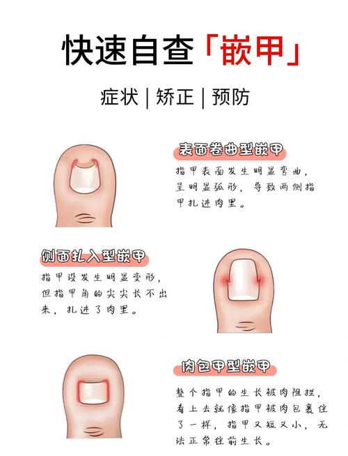 错误剪指甲导致嵌甲示意图