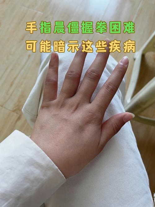 晨起握拳关节发僵实拍图
