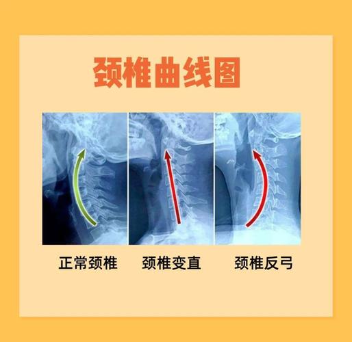 错误高度枕头颈椎弯曲示意图