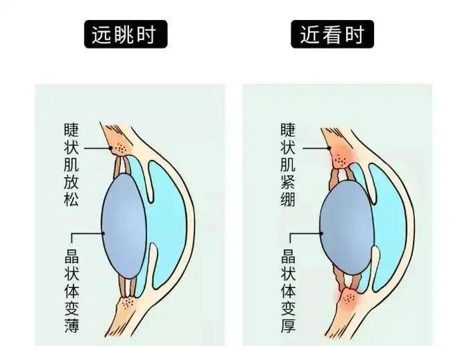 人眼睫状肌紧张放松对比示意图
