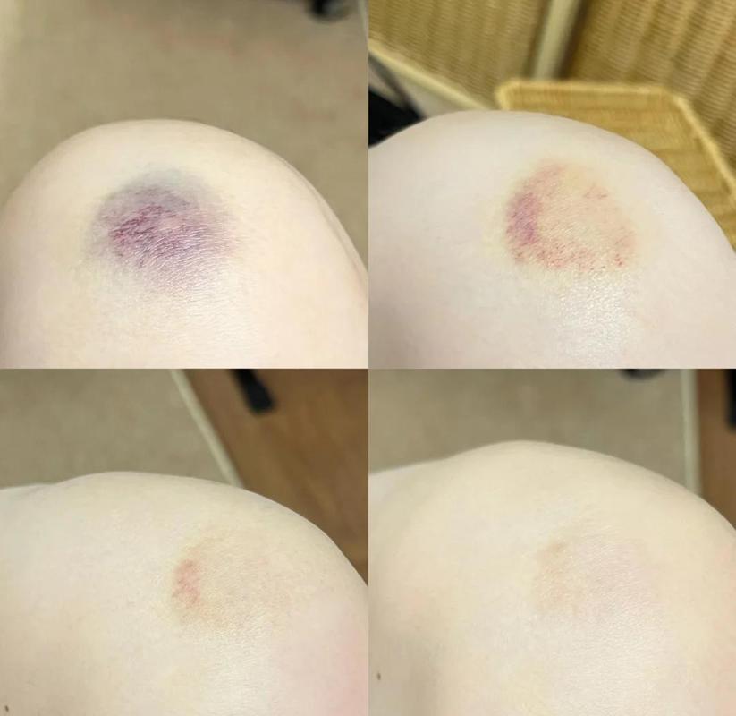 轻度磕碰后皮下淤血对比图