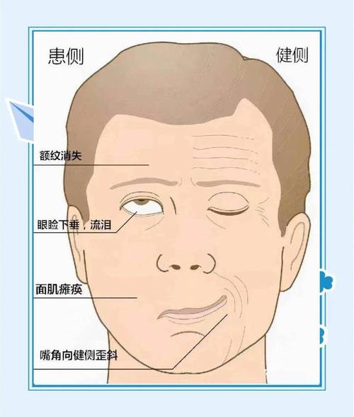 面神经炎患侧眼睛闭合不全示意图