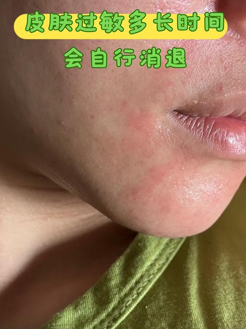 一、过敏,最会伪装的“模仿犯”