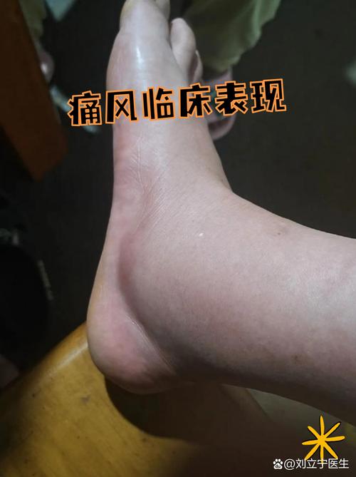 痛风急性期大脚趾关节红肿示意图
