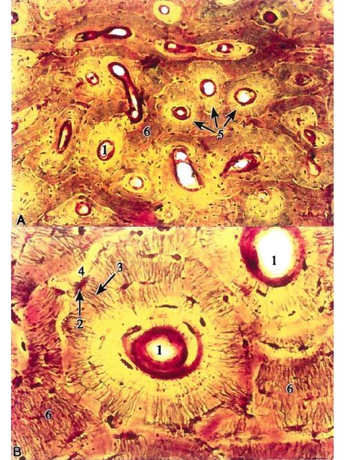氧化锆陶瓷人工关节磨损颗粒引发骨溶解病理切片