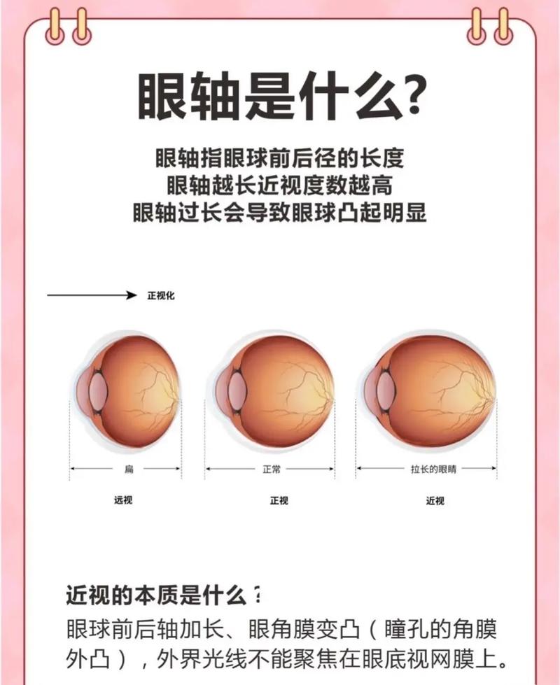 近视眼轴拉长对比示意图