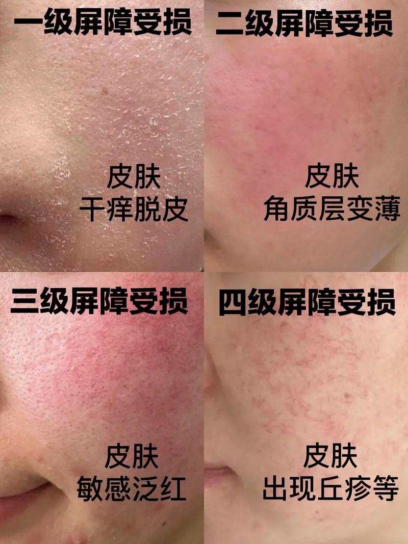 皮肤过度清洁导致泛红屏障受损对比实拍