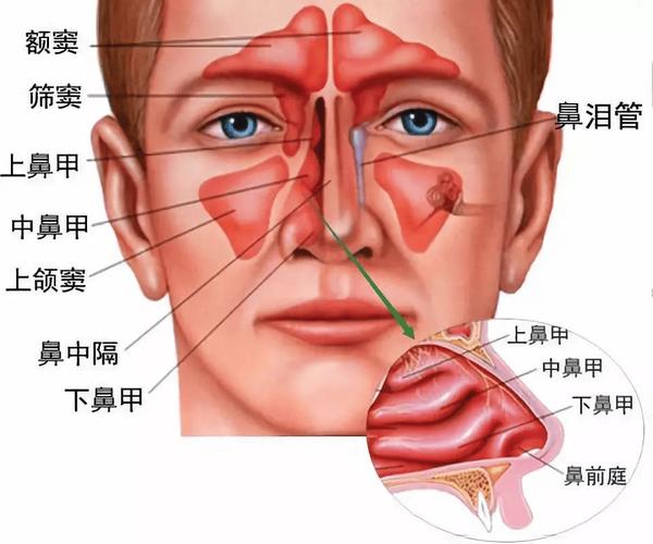 人体鼻腔黏膜肿胀示意图