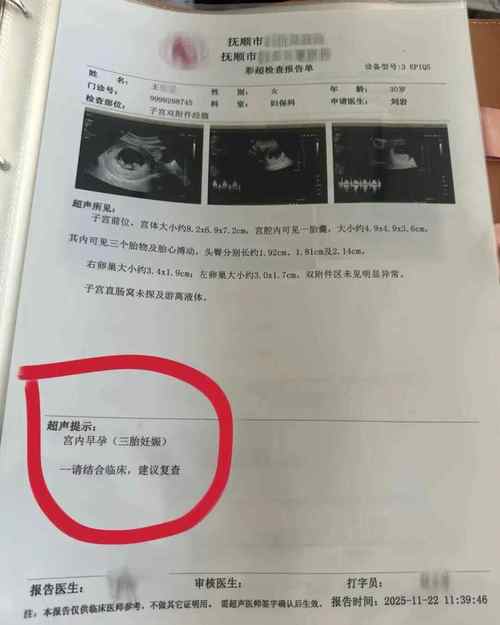 孕妇手持早期B超单特写