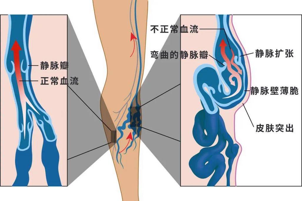 久坐2小时下肢血液循环瘀滞对比示意图