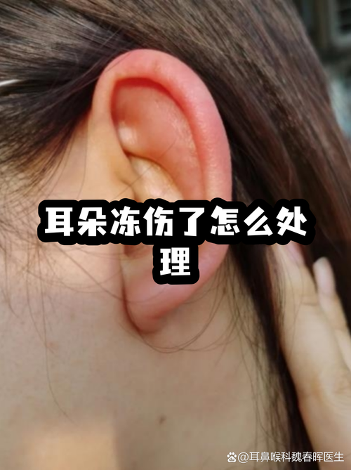 冬天户外耳朵冻伤红肿图片