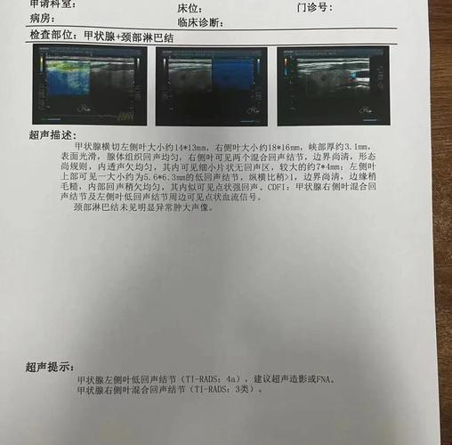 体检报告甲状腺结节异常标注图