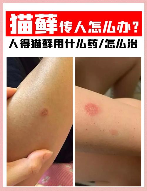 大家最关心：猫藓会传染给人吗？