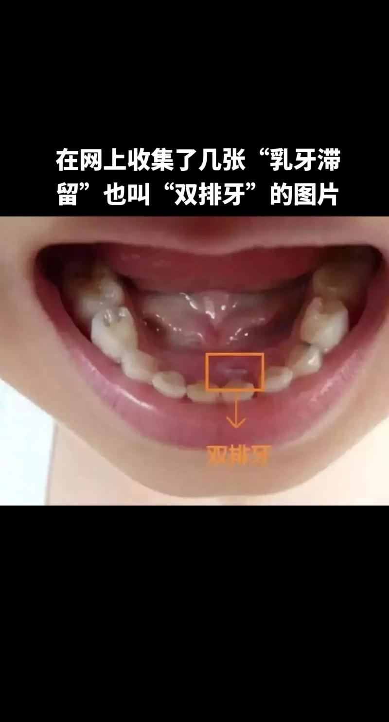 不儿戏!牙齿记录是宝宝护牙的第一道防线-超级宝贝