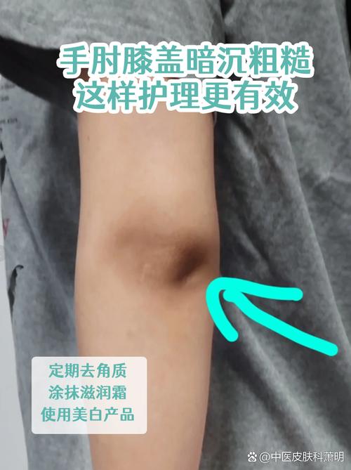 新娘婚前身体护理手肘膝盖细节图