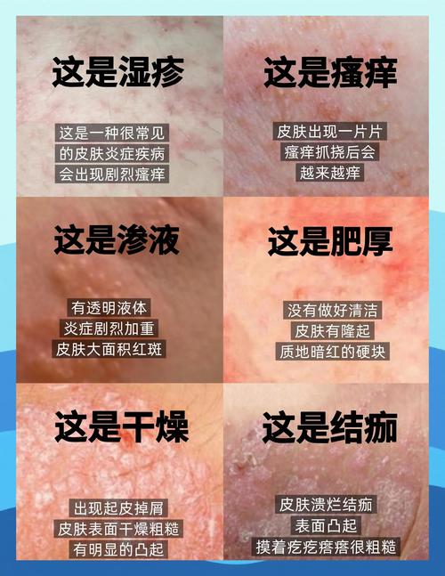 湿疹：保湿才是终极武器