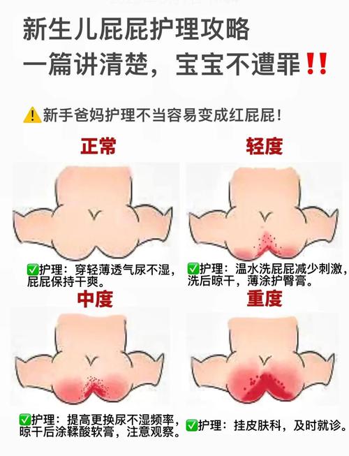 踩过坑才发现的宝宝臀部护理误区