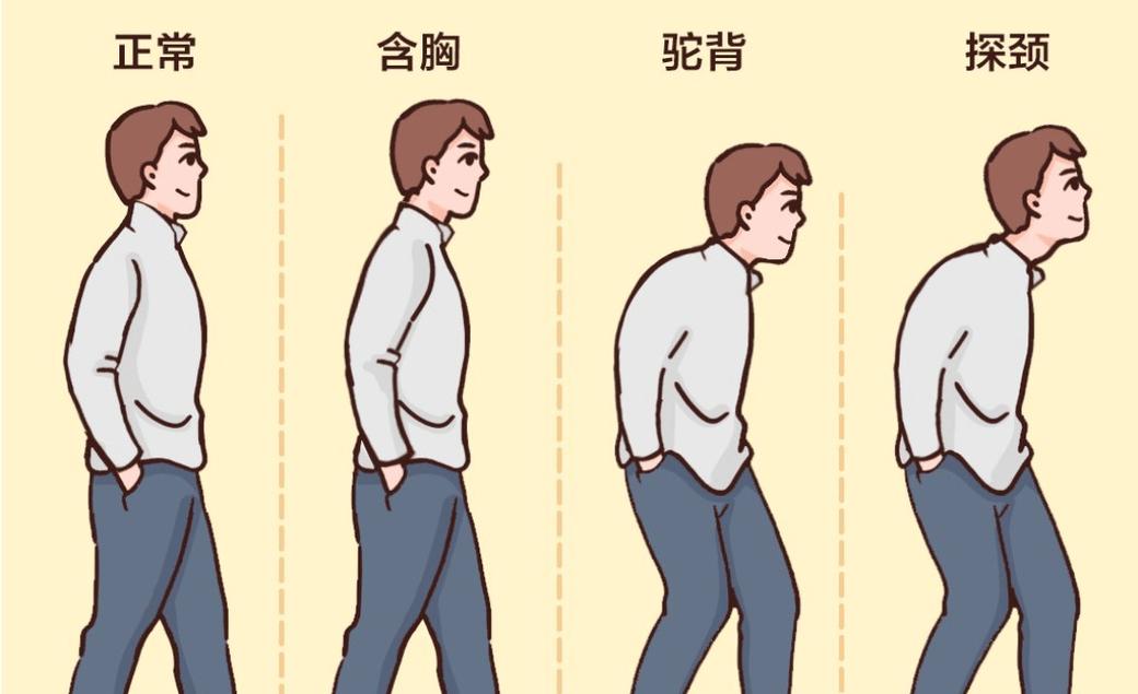 男女侧面驼背姿态对比示意图