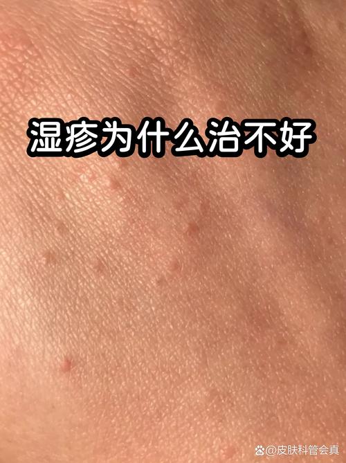 为什么治了好久还反复