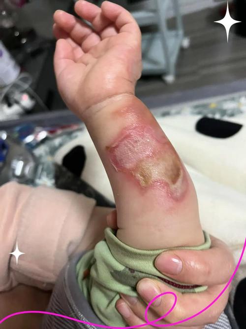 宝宝烧烫伤禁用偏方物品集合图